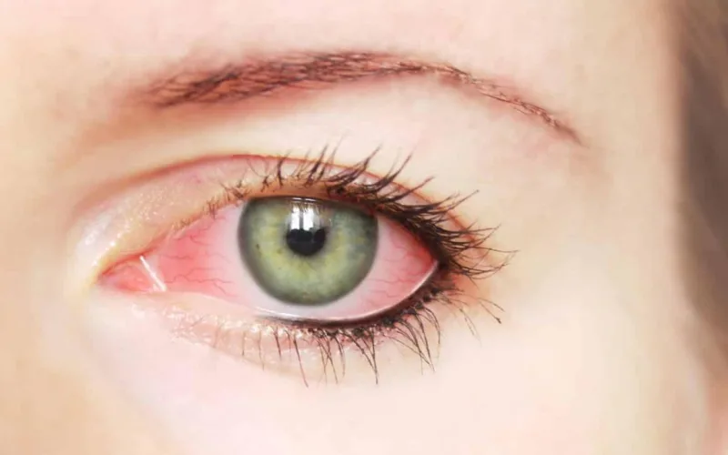 تجربتي مع علاج ارتشاح العين بالاعشاب بوصفة منزلية آمنة وفعالة