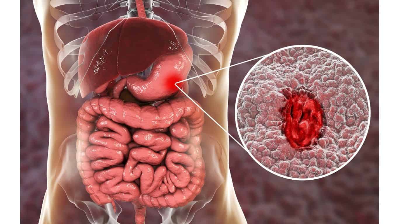 تجربتي مع علاج الاميبا بالاعشاب للأطفال والكبار