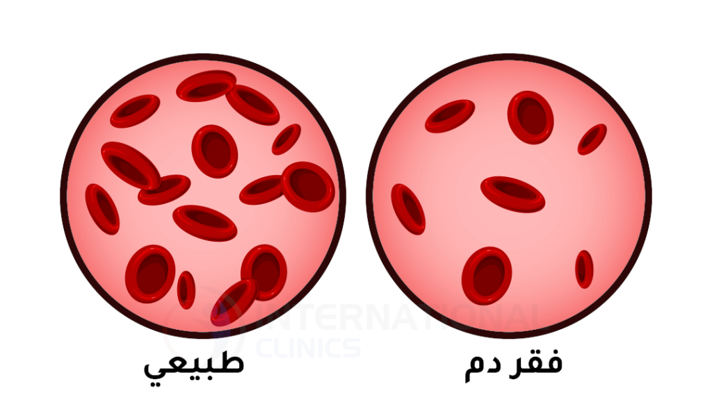 أعراض الاصابة بفقر الدم وعلاجه